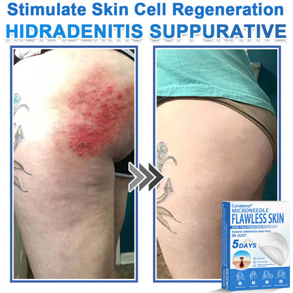 🩹 Curalona® 2-in-1 Microneedle & Hydrocolloid Patch | Raised Moles,Acne,  Flat Warts & Skin Tags Remover | Improves Wrinkles, Scars & Blemishes | Invisible Pimple Patches for Face & Body