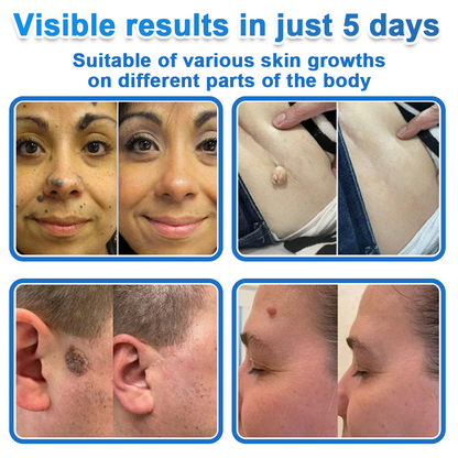 🩹 Curalona® 2-in-1 Microneedle & Hydrocolloid Patch | Raised Moles,Acne,  Flat Warts & Skin Tags Remover | Improves Wrinkles, Scars & Blemishes | Invisible Pimple Patches for Face & Body