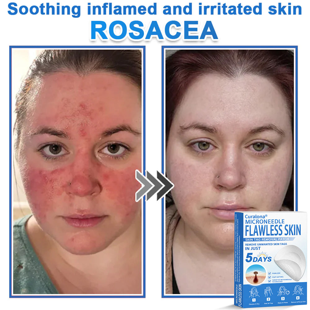 🩹 Curalona® 2-in-1 Microneedle & Hydrocolloid Patch | Raised Moles,Acne,  Flat Warts & Skin Tags Remover | Improves Wrinkles, Scars & Blemishes | Invisible Pimple Patches for Face & Body