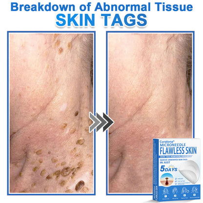 🩹 Curalona® 2-in-1 Microneedle & Hydrocolloid Patch | Raised Moles,Acne,  Flat Warts & Skin Tags Remover | Improves Wrinkles, Scars & Blemishes | Invisible Pimple Patches for Face & Body