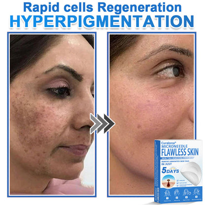 🩹 Curalona® 2-in-1 Microneedle & Hydrocolloid Patch | Raised Moles,Acne,  Flat Warts & Skin Tags Remover | Improves Wrinkles, Scars & Blemishes | Invisible Pimple Patches for Face & Body